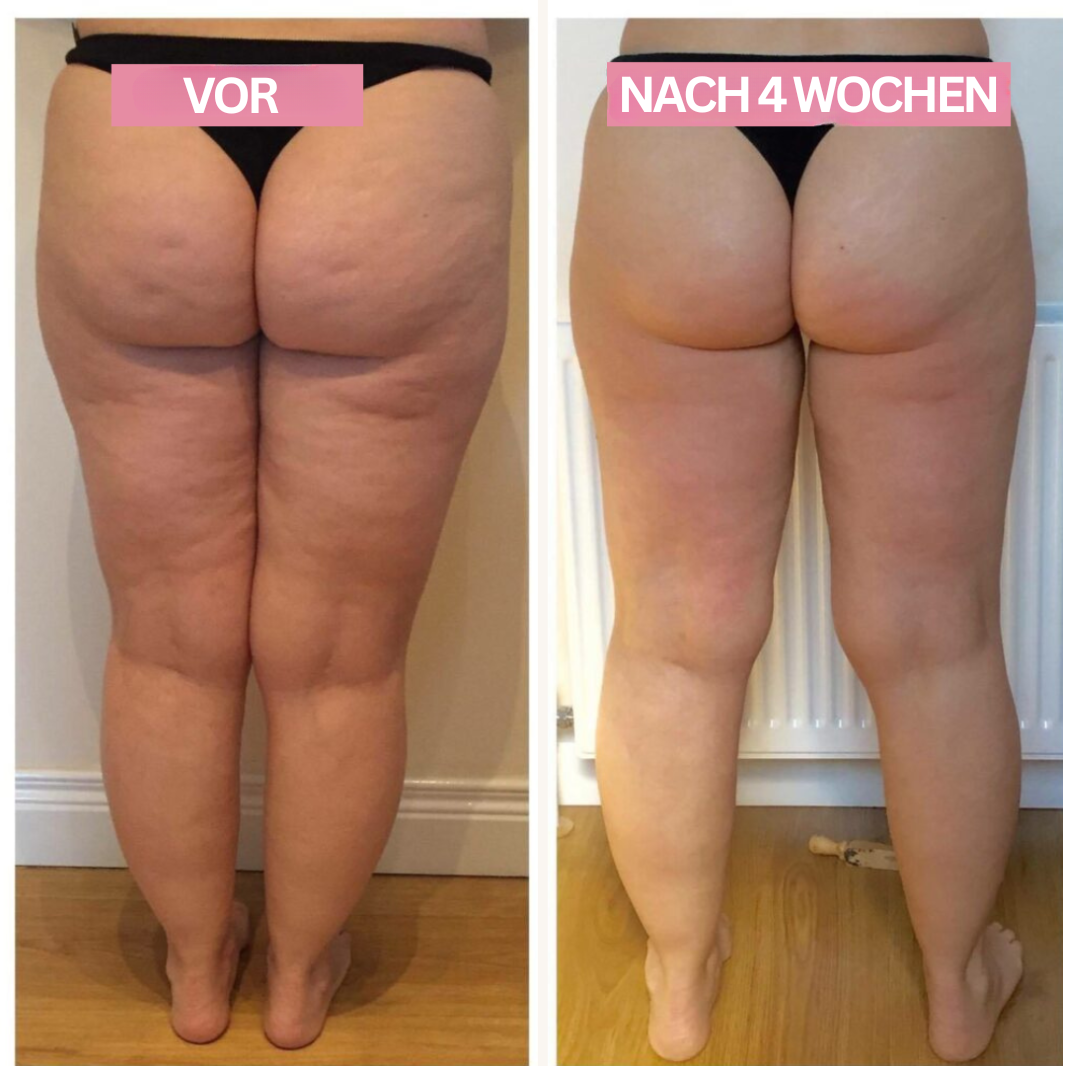 Cupping-apparaat voor Thuisgebruik 7